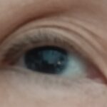 Eye Problem