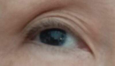 Eye Problem